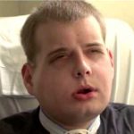 புதிய முகம்: முகமாற்று அறுவை சிகிசையில் சாதனை Alt